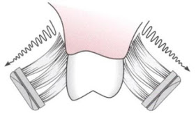 Stillman Method Image