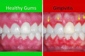 Gingivitis Image