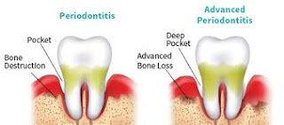 Periodontitis Image