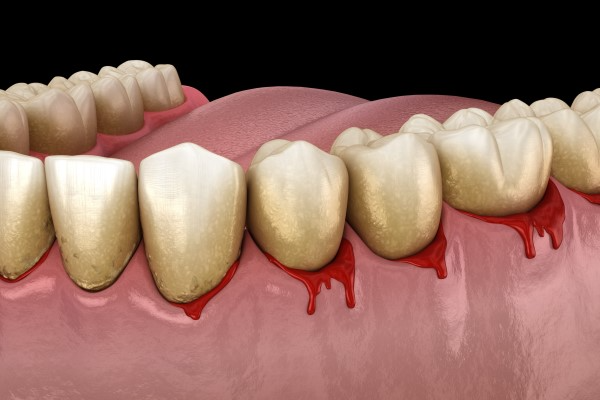 Gum-bleeding Image