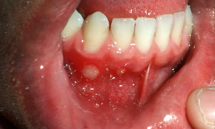 OralUlcers Image