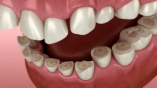 Teeth Attrition